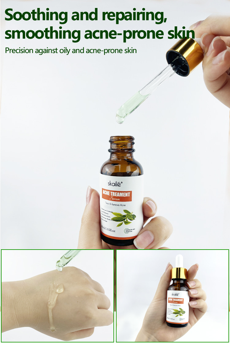 Acne Treatment Serum